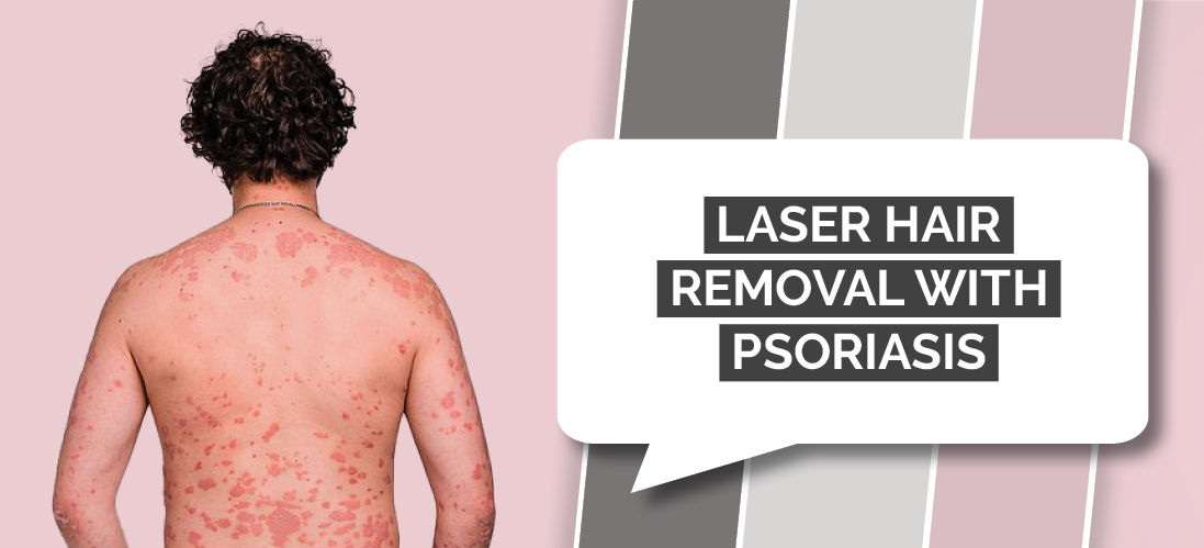Laser Hair Removal with Psoriasis - Laser Hair Removal Near Me: The Largest  Directory of Laser Hair Removal Companies