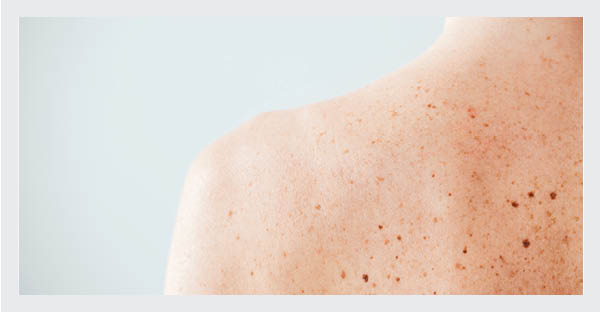 Can you get laser hair removal over freckles or birthmarks?