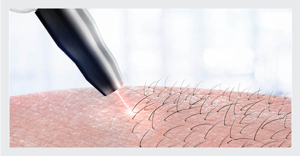 Laser hair removal is a versatile service. Did you know laser hair removal is one of the best methods to rid yourself of hair on the buttocks?