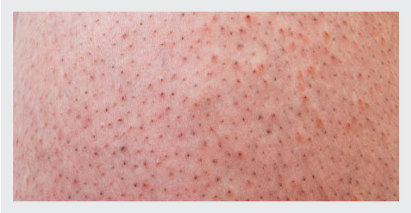 Pores on the legs can be clogged with oil, dead skin, or bacteria and usually made worse with shaving