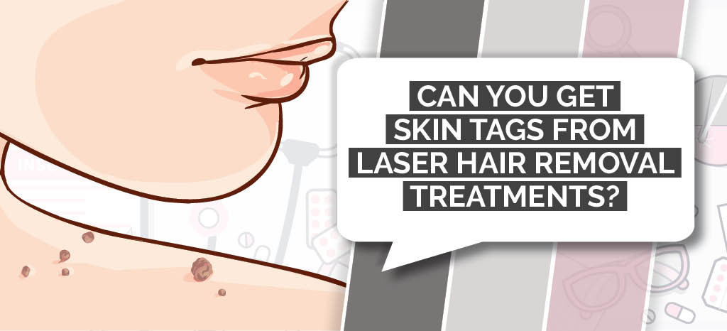 Can laser hair removal treatments give you skin tags?