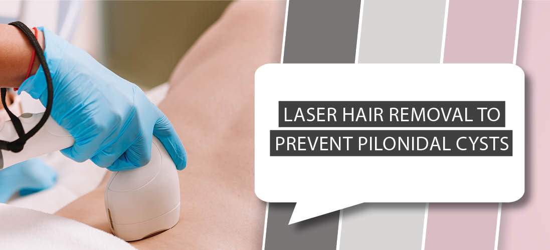 Laser hair removal for pilonidal cysts